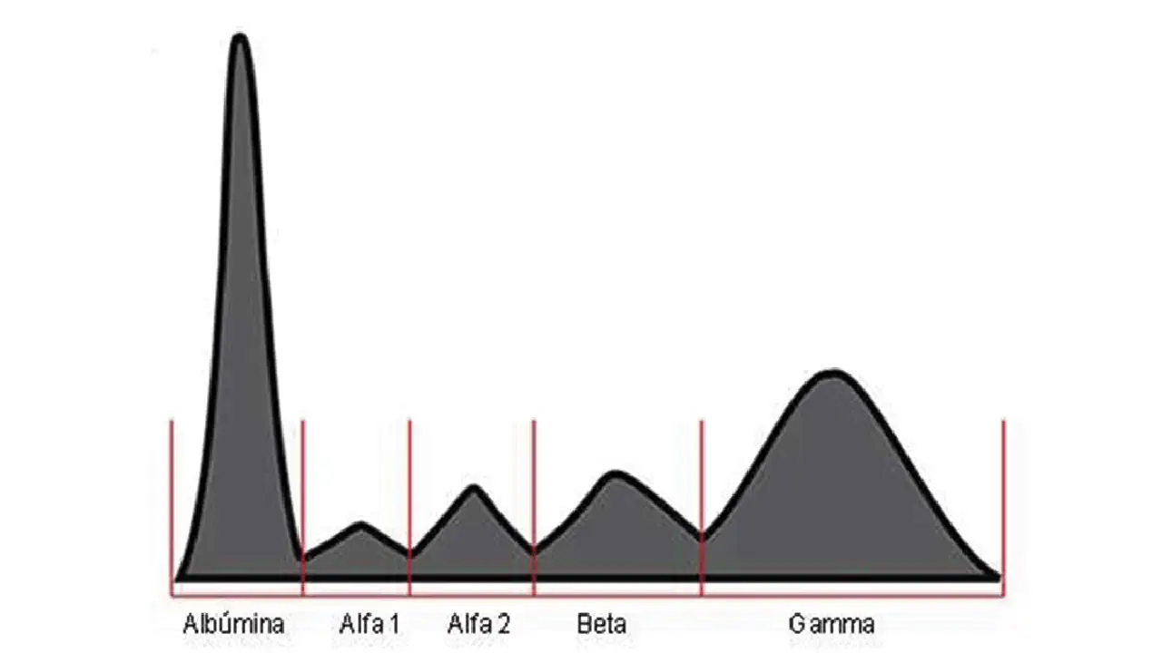 Systemic Lupus Erythematosus and Albumin-Globulin Index, a specific finding in lupus flares?